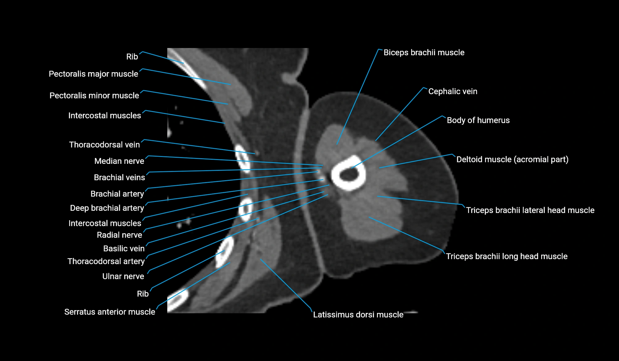 CT upper arm axial  cross sectional anatomy labelled radiology image -00186.webp